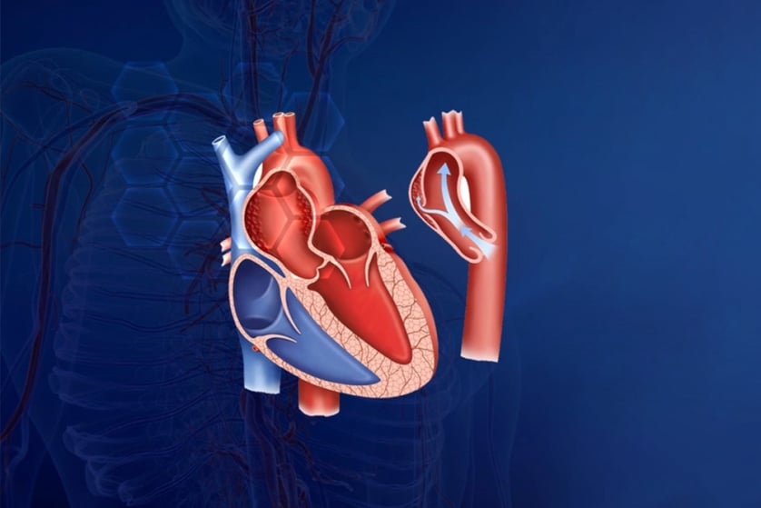aort-anevrizmasi