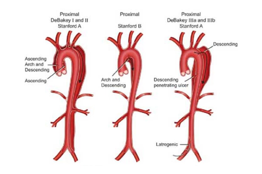 aort-disseksiyonu