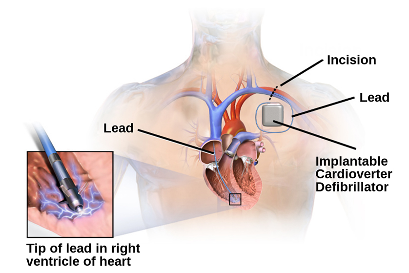 implantable-cardioverter-defibrillator